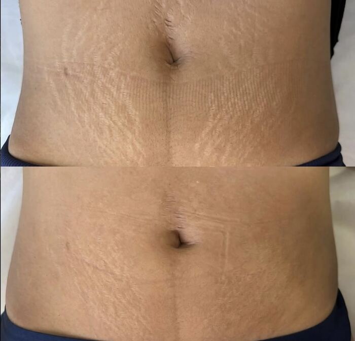 Stretch mark camouflage result