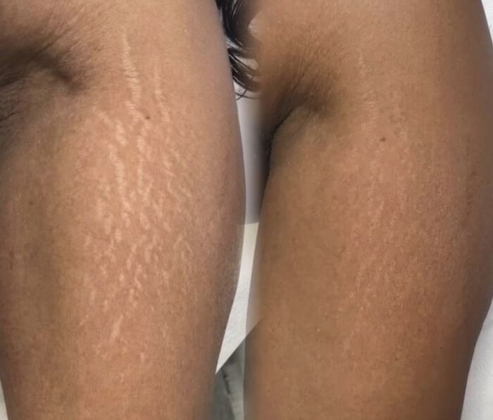 Stretch mark camouflage result