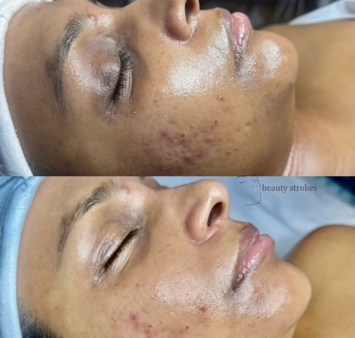 Acne Scar Transformation